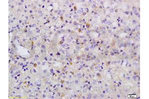 Formalin-fixed and paraffin embedded human liver carcinoma labeled with Anti-Phospho-Wee1(Ser642) Polyclonal Antibody, Unconjugated (ABIN746873) at 1:200 followed by conjugation to the secondary antibody and DAB (WEE1 antibody  (pSer642))