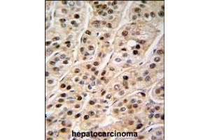 Formalin-fixed and paraffin-embedded human hepatocarcinoma tissue reacted with PCNA antibody , which was peroxidase-conjugated to the secondary antibody, followed by DAB staining. (PCNA antibody  (C-Term))