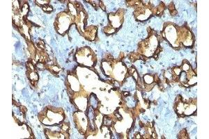 Formalin-fixed, paraffin-embedded human angiosarcoma stained with CD34 antibody (QBEnd/10 + HPCA1/763) (CD34 antibody)