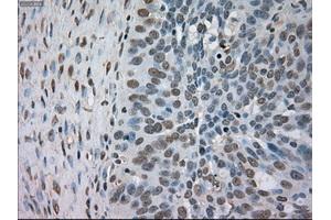 Immunohistochemical staining of paraffin-embedded Adenocarcinoma of colon tissue using anti-BUB1Bmouse monoclonal antibody. (BUB1B antibody)