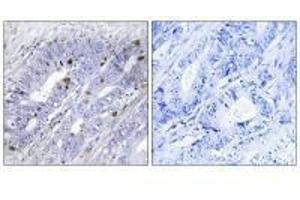 Immunohistochemistry analysis of paraffin-embedded human colon carcinoma tissue using Nuclear Receptor NR4A1 (Ab-351) antibody. (NR4A1 antibody  (Ser351))