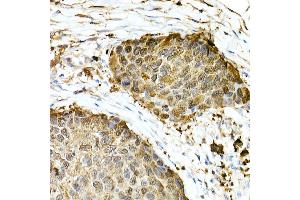 Immunohistochemistry of paraffin-embedded Human esophageal cancer using GST3/GSTP1 antibody (ABIN7267448) at dilution of 1:100 (40x lens). (GSTP1 antibody)