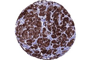 Strong inhibin alpha immunostaining in all cells of an adrenocortical adenoma (Recombinant Inhibin alpha antibody  (AA 233-362))