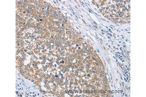 Immunohistochemistry of Human gastric cancer using PAPSS1 Polyclonal Antibody at dilution of 1:40