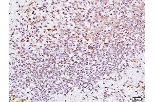 Formalin-fixed and paraffin embedded human gastric carcinoma labeled with Anti CENPF Polyclonal Antibody, Unconjugated (ABIN872667) at 1:200 followed by conjugation to the secondary antibody and DAB staining. (CENPF antibody  (AA 551-650))