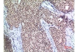 Immunohistochemistry (IHC) analysis of paraffin-embedded Human Mammary Cancer, antibody was diluted at 1:100. (P57 (Ser24) antibody)