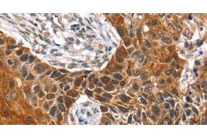 Immunohistochemistry of paraffin-embedded Human esophagus cancer tissue using HOXB1 Polyclonal Antibody at dilution 1:40 (HOXB1 antibody)