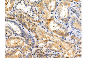 ABIN6258004 and ABIN6275034 at 1/100 staining Human kidney cancer and adjacent normal tissues by IHC-P.