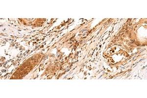 Immunohistochemistry of paraffin-embedded Human esophagus cancer tissue using SCAND1 Polyclonal Antibody at dilution of 1:90(x200) (SCAND1 antibody)
