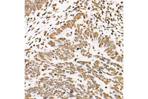 Immunohistochemistry of paraffin-embedded human colon carcinoma using Phospho-ST-Y705 Rabbit mAb (ABIN6135325, ABIN6136266, ABIN6136267 and ABIN7101883) at dilution of 1:100 (40x lens). (STAT3 antibody  (pTyr705))