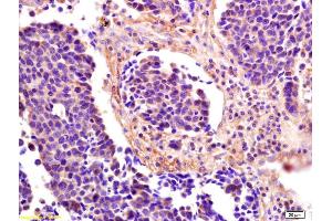 Formalin-fixed and paraffin embedded human lung carcinoma labeled with Anti-ICOS-L/B7-H2/CD275 Polyclonal Antibody, Unconjugated (ABIN740745) at 1:200 followed by conjugation to the secondary antibody and DAB staining. (ICOSLG antibody  (AA 19-120))
