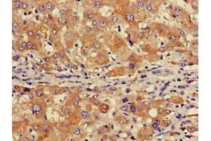 Immunohistochemistry of paraffin-embedded human liver cancer using ABIN7153517 at dilution of 1:100