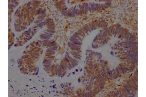 IHC image of ABIN7127524 diluted at 1:100 and staining in paraffin-embedded human ovarian cancer performed on a Leica BondTM system. (Recombinant GRB2 antibody)