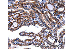 Immunohistochemistry of Human thyroid cancer using FBN1 Polyclonal Antibody at dilution of 1:40 (Fibrillin 1 antibody)