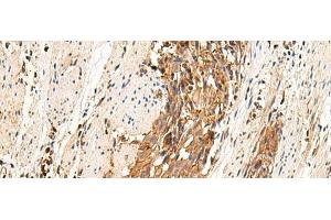 Immunohistochemistry of paraffin-embedded Human esophagus cancer tissue using MRGPRD Polyclonal Antibody at dilution of 1:25(x200) (MRGPRD antibody)