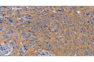 Immunohistochemistry of paraffin-embedded Human cervical cancer tissue using BOD1 Polyclonal Antibody at dilution 1:60 (BOD1 antibody)