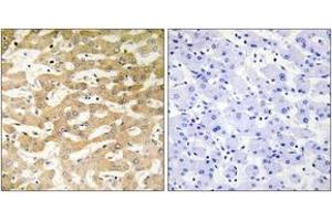 Immunohistochemistry analysis of paraffin-embedded human liver carcinoma tissue, using FADD Antibody.