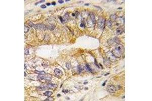 IHC analysis of FFPE human prostate carcinoma tissue stained with PDGFRA antibody (PDGFRA antibody  (AA 746-775))