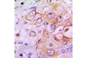 Immunohistochemical analysis of PFKFB2 staining in human lung cancer formalin fixed paraffin embedded tissue section. (PFKFB2 antibody  (N-Term))