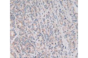 IHC-P analysis of Human Prostate Gland Cancer Tissue, with DAB staining. (VNN1 antibody  (AA 36-223))