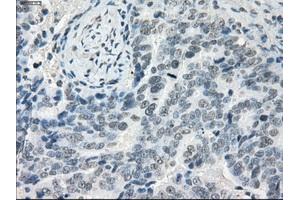 Immunohistochemical staining of paraffin-embedded Adenocarcinoma of colon tissue using anti-LTA4H mouse monoclonal antibody. (LTA4H antibody)