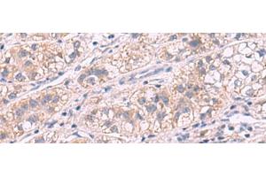 Immunohistochemistry of paraffin-embedded Human liver cancer tissue using G6PC Polyclonal Antibody at dilution of 1:50(x200)