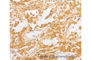 Immunohistochemistry of Human thyroid cancer using PDE4D Polyclonal Antibody at dilution of 1:20 (PDE4D antibody)