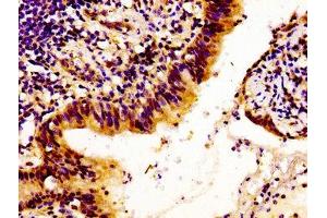 Immunohistochemistry of paraffin-embedded human lung cancer using ABIN7157878 at dilution of 1:100