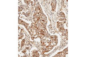 Immunohistochemical analysis of paraffin-embedded Human breast carcinoma tissue using (ABIN6243695 and ABIN6578909) performed on the Leica® BOND RXm. (HSP70 1A antibody)