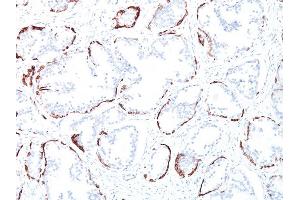 Formalin-fixed, paraffin-embedded human Prostate Carcinoma stained with Cytokeratin, HMW Mouse Monoclonal Antibody (34BE12).