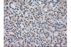Immunohistochemical staining of paraffin-embedded Carcinoma of kidney tissue using anti-CTAG1Bmouse monoclonal antibody.