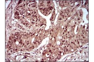 Immunohistochemical analysis of paraffin-embedded rectum cancer tissues using DAPK3 mouse mAb with DAB staining.