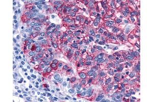 Anti-FZD3 / Frizzled 3 antibody IHC of human Ovary, Carcinoma. (FZD3 antibody)