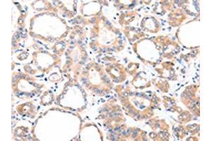 The image on the left is immunohistochemistry of paraffin-embedded Human thyroid cancer tissue using ABIN7128109(AADACL2 Antibody) at dilution 1/25, on the right is treated with fusion protein. (AADACL2 antibody)