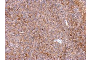 IHC-P Image Immunohistochemical analysis of paraffin-embedded PC13 xenograft, using PHGDH, antibody at 1:500 dilution. (PHGDH antibody  (N-Term))