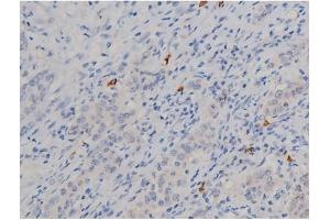 ABIN6267338 at 1/200 staining Human ganstric cancer tissue sections by IHC-P.