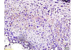 Formalin-fixed and paraffin embedded human breast cancer labeled with Anti-Arhgef2/GEF H1 Polyclonal Antibody, Unconjugated (ABIN705161) followed by conjugation to the secondary antibody and DAB staining