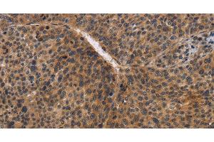 Immunohistochemistry of paraffin-embedded Human liver cancer using CDC34 Polyclonal Antibody at dilution of 1:50 (CDC34 antibody)