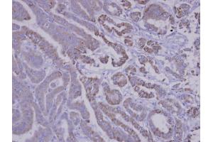 IHC-P Image Immunohistochemical analysis of paraffin-embedded human thyroid cancer, using SNX12, antibody at 1:100 dilution. (SNX12 antibody  (C-Term))