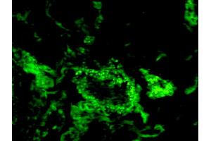 Formalin-fixed and paraffin-embedded human breast cancer labeled with Anti-CD150/SLAMF1 Polyclonal Antibody, Unconjugated (ABIN749468) 1:200, overnight at 4°C, The secondary antibody was Goat Anti-Rabbit IgG, FITC conjugated used at 1:200 dilution for 40 minutes at 37°C. (SLAMF1 antibody  (AA 231-335))