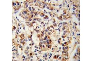 Immunohistochemistry analysis of human breast carcinoma (Formalin-fixed, Paraffin-embedded) using SPRR1B / Cornifin-B Antibody (C-term), followed by peroxidase-conjugated secondary antibody and DAB staining. (SPRR1B antibody  (C-Term))