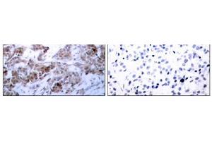 Immunohistochemical analysis of paraffin-embedded human breast carcinoma tissue using BCL-2 (Ab-70) antibody (E021060). (Bcl-2 antibody)