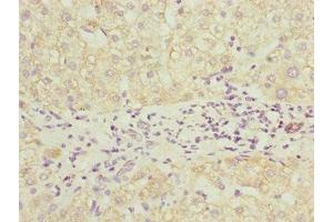 Immunohistochemistry of paraffin-embedded human liver cancer using ABIN7164691 at dilution of 1:100 (PDCD2L antibody  (AA 1-358))