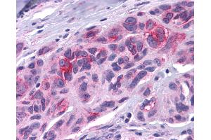 Anti-DUSP23 antibody IHC of human Skin, Melanoma. (DUSP23 antibody  (Internal Region))