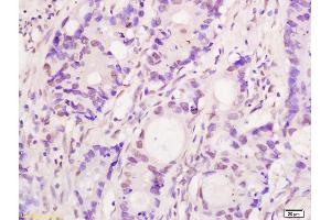 Formalin-fixed and paraffin embedded human colon carcinoma labeled with Anti-Bub1 Polyclonal Antibody, Unconjugated (ABIN706541) at 1:200 followed by conjugation to the secondary antibody and DAB staining (BUB1 antibody  (AA 951-1085))