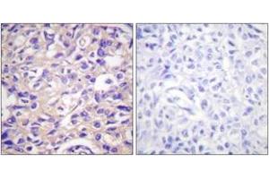 Immunohistochemistry analysis of paraffin-embedded human breast carcinoma, using TK (Phospho-Ser13) Antibody. (TK (AA 1-50), (pSer13) antibody)