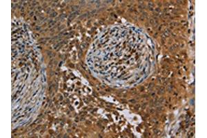 The image on the left is immunohistochemistry of paraffin-embedded Human cervical cancer tissue using ABIN7191746(OSM Antibody) at dilution 1/40, on the right is treated with synthetic peptide. (Oncostatin M antibody)