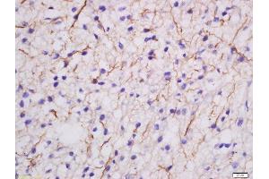 Formalin-fixed and paraffin embedded human glioma labeled with Rabbit Anti-MDGA2 Polyclonal Antibody, Unconjugated  at 1:200 followed by conjugation to the secondary antibody and DAB staining