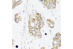 Immunohistochemistry of paraffin-embedded human gastric cancer using IER3 antibody (ABIN6134174, ABIN6142158, ABIN6142159 and ABIN6224665) at dilution of 1:100 (40x lens). (IER3 antibody  (C-Term))