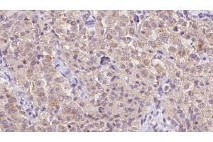 ABIN6273349 at 1/100 staining Human thyroid cancer tissue by IHC-P. (WSB1 antibody  (Internal Region))
